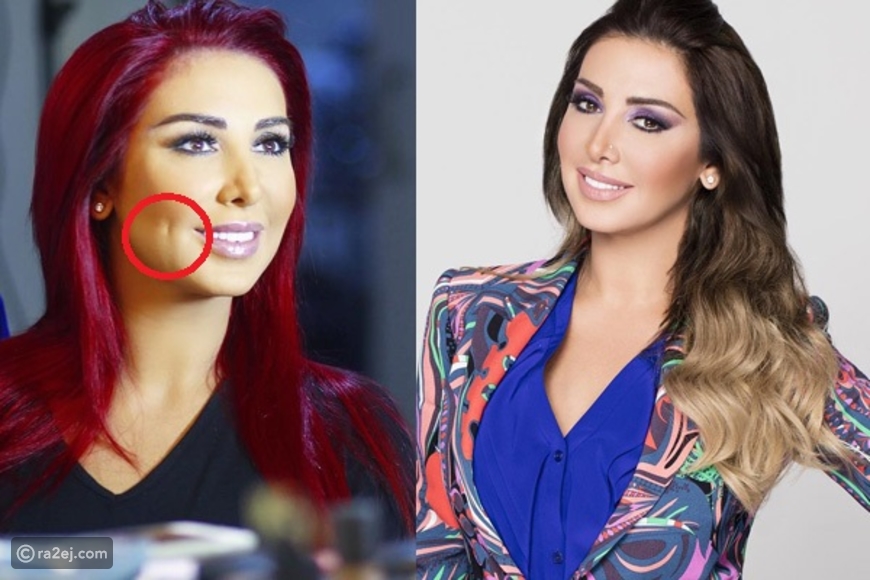 غمازات جويل ماردينيان بعد التجميل أصبحوا علامة فارقة