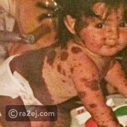 صور سيرا الطفلة الملقبة بـ "الكلب المرقط" بعد ان أصبح عمرها 19 عاماً