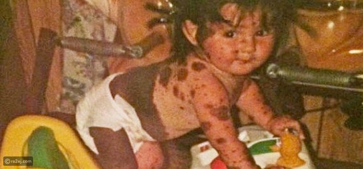 صور سيرا الطفلة الملقبة بـ "الكلب المرقط" بعد ان أصبح عمرها 19 عاماً