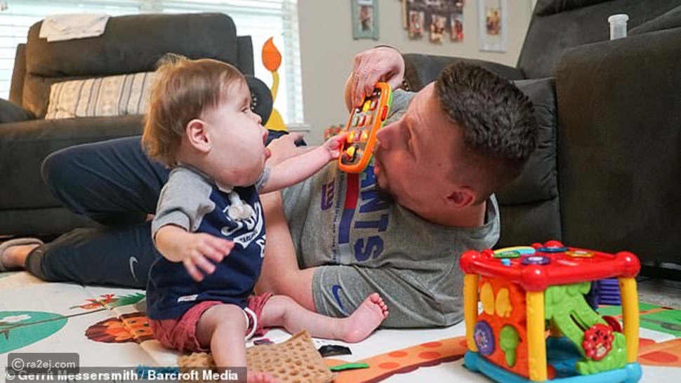 حالة نادرة لطفل يولد بخدود ضحمة للغاية رائج